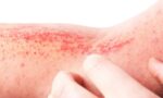 New Biologic Drug Approved for Moderate to Severe Atopic Dermatitis