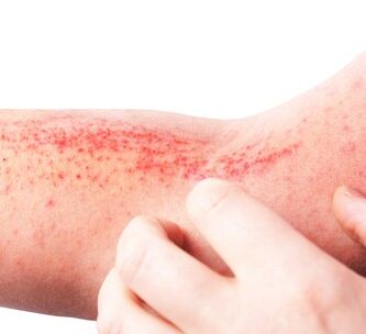 New Biologic Drug Approved for Moderate to Severe Atopic Dermatitis