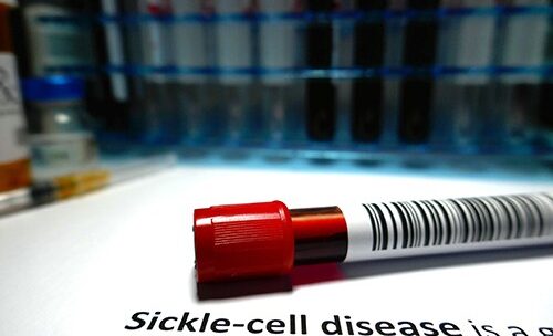 New Therapy for Sickle Cell Disease