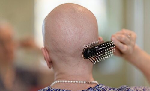 Janus Kinase Inhibitor Treatment Approved for Severe Alopecia Areata