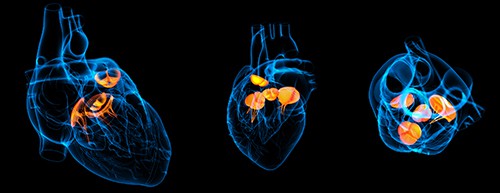 First Transcatheter Therapy for Tricuspid Valve Replacement Gains FDA Approval